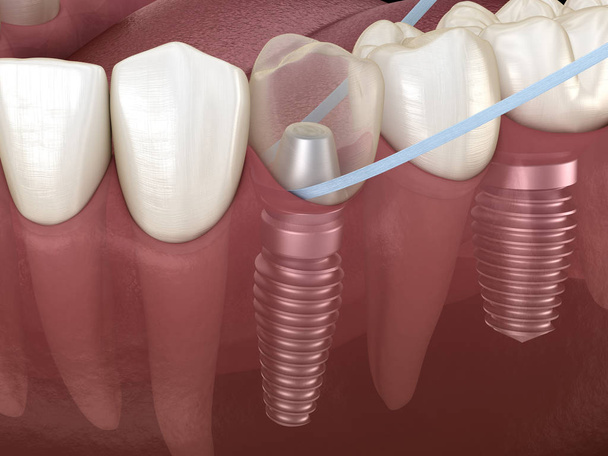 Limpieza dental de implantes con hilo dental. Ilustración 3D médicamente precisa
 - Foto, imagen