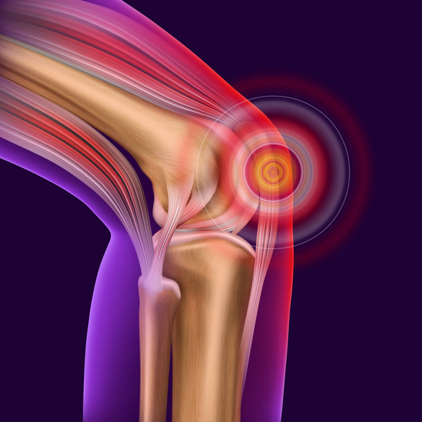 Knee pain. Trauma to the leg, patella, knee joint. Medical neon vector illustration isolated on a dark background. - Vector, Image
