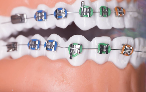 Fogászati konzolok fogak kiegyenesítők - Fotó, kép