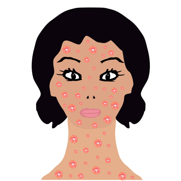 Rash on face and neck. Allergy, dermatitis, acne, pimples. Infographics. Vector illustration on isolated background. - Vector, Image