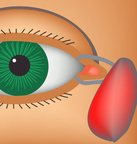 Dacryocyst. Inflammation of the lacrimal sac of the eye. The structure of the eye. Infographics. Vector illustration - Vector, Image