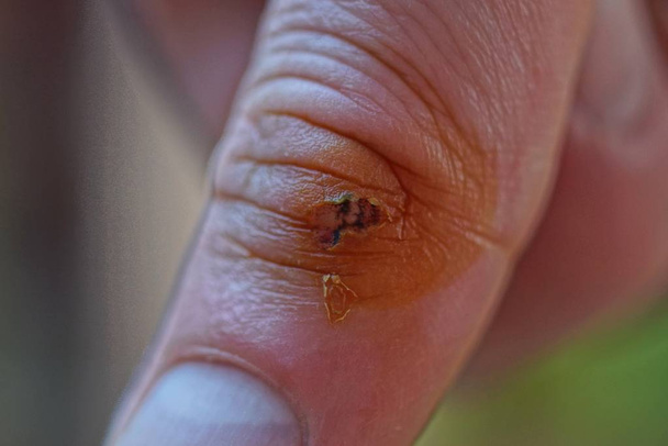 una gran herida en la piel gris del dedo
 - Foto, Imagen