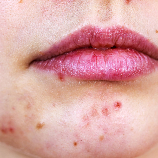 Female face with acne skin problem - Zdjęcie, obraz