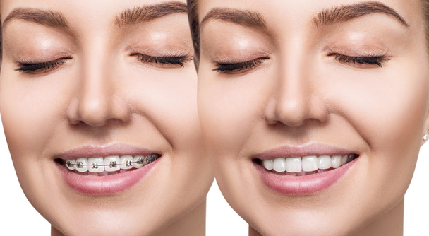 Kaunis hymy täydellisillä hampailla ennen ja jälkeen hammasraudat
. - Valokuva, kuva