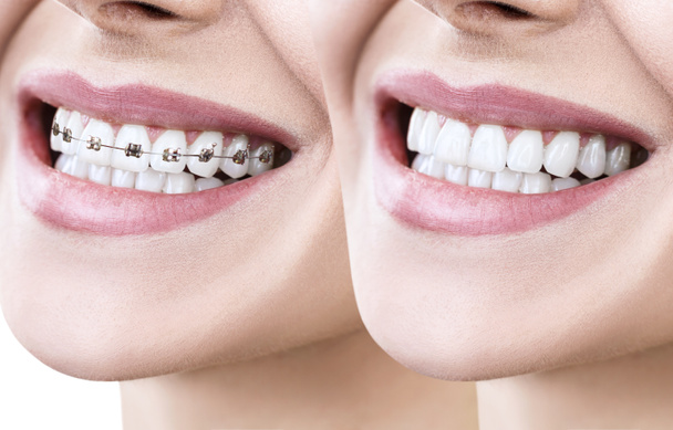 Parantez öncesi ve sonrası mükemmel dişleri ile güzel bir gülümseme. - Fotoğraf, Görsel
