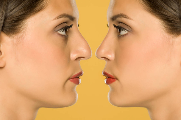 jovem mulher beuatifull antes e depois da cirurgia do nariz
 - Foto, Imagem