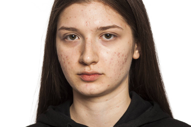 tizenéves lány problémás bőr fehér háttér - Fotó, kép