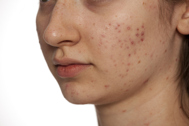 closeup of teenage girl with problematic skin on white background - Foto, Imagem