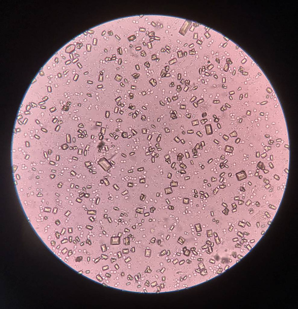 Virtsa-analyysin havainto mikroskoopilla osoittaa kristallibakteerit ja
 - Valokuva, kuva