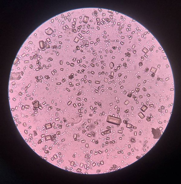 L'analisi delle urine con microscopio mostra batteri cristallini e
 - Foto, immagini
