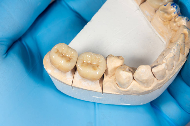 κορώνες του ζιρκόνιο των ανθρώπινων δοντιών κοντά στο χέρι ενός οδοντοστοιχία - Φωτογραφία, εικόνα
