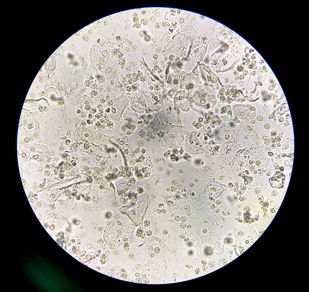Bactérias moderadas e glóbulos brancos na urina das bactérias do paciente
 - Foto, Imagem