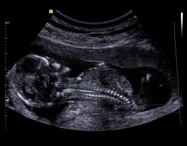 Ultrasound Baby - Photo, Image
