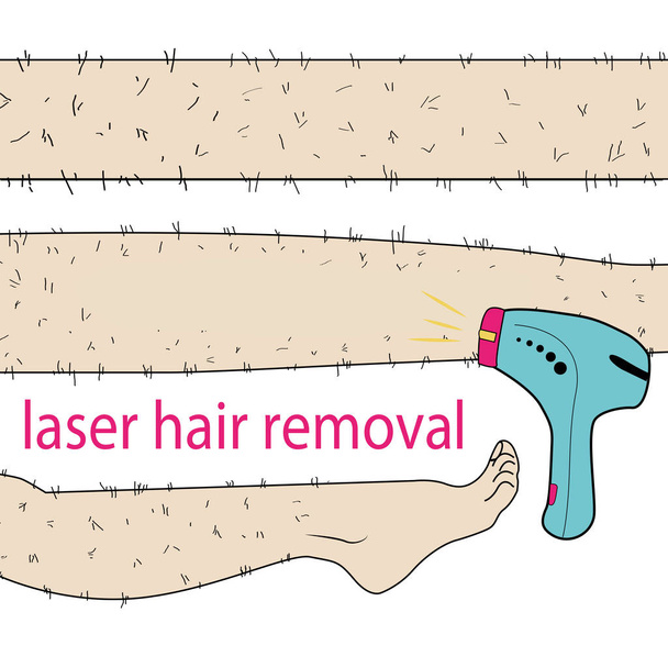 Skizze in Vektor gezeichnet: Frau entfernt Haare von haarigen Beinen mit Laser-Haarentfernung auf isoliertem Hintergrund - Vektor, Bild