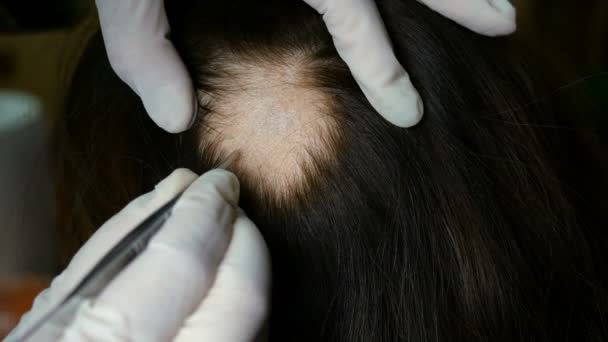 Женская потеря волос. Врач или косметолог проводит осмотр, делает процедуры, головы женщины на коже которых нет волос. Может, это алопеция, лишайник, трихопетия, микроспория. Крупный план
 - Кадры, видео