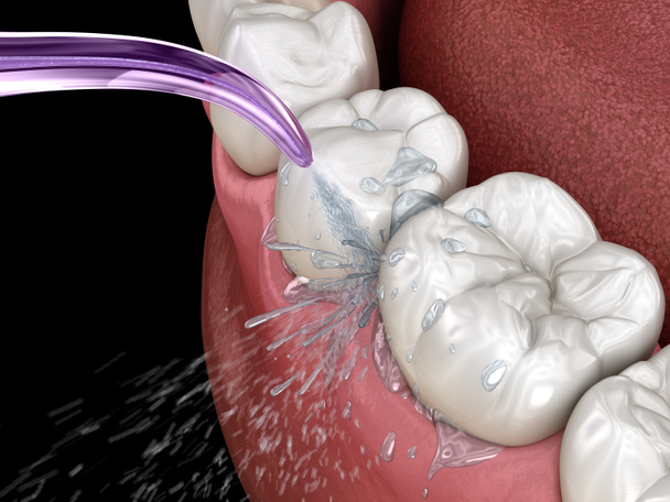 Riego, limpieza de dientes de agua. Ilustración 3D médicamente precisa de la higiene bucal
. - Foto, Imagen