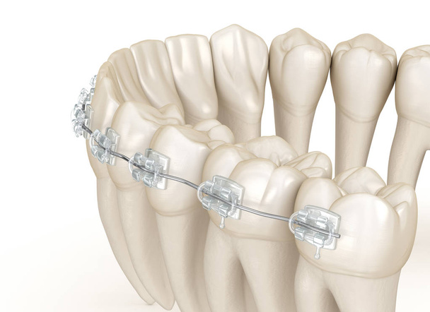 Teeth and Clear braces. 3D illustration concept - Photo, Image