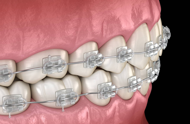 Dientes Tirantes transparentes. Ilustración dental 3D médicamente precisa
 - Foto, Imagen