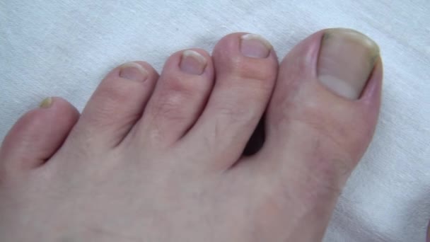Large uncut toenails with fungus. The man has yellow toenails. Long did not cut your nails - Footage, Video