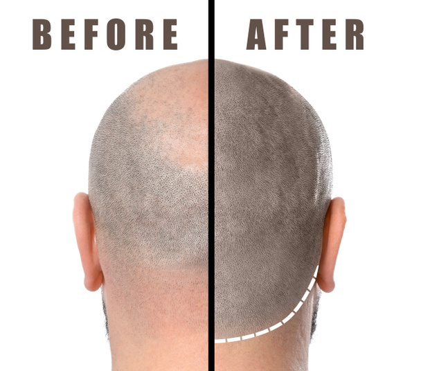 Mann vor und nach der Haarausfallbehandlung auf weißem Hintergrund - Foto, Bild