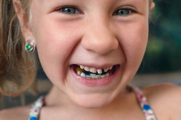 Petite fille avec appareil orthodontique et dent vacillante
 - Photo, image