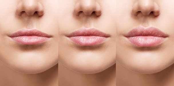 Lips of young woman before and after augmentation. - Photo, Image