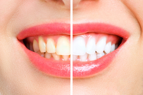 vrouw tanden vóór en na whitening. op witte achtergrond - Foto, afbeelding
