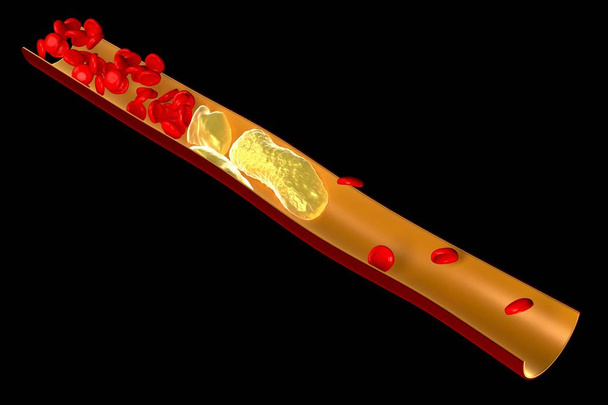 3D koleszterin, vérrög, vörösvértestek - Fotó, kép