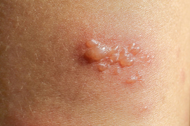 skin rash as allergic symptoms due to arm fiberglass cast - Photo, Image