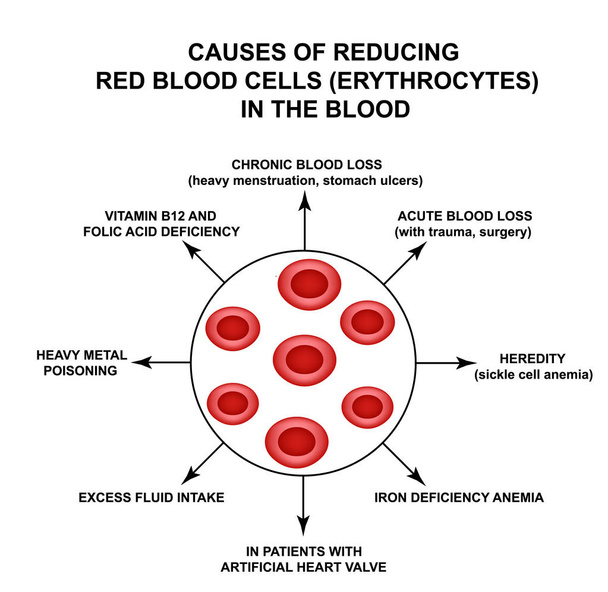 Příčiny snížení červených krvinek. Buňky erytrocyty. Hemoglobin. Struktura červených krvinek. Informační grafika. Vektorová ilustrace na izolovaném pozadí. - Vektor, obrázek