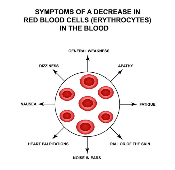 Συμπτώματα μείωσης των ερυθρών αιμοσφαιρίων στο αίμα. Κύτταρα ερυθροκυττάρων. Αιμοσφαιρίνης. Η δομή των ερυθρών αιμοσφαιρίων. Infographics. Απεικόνιση διανύσματος σε απομονωμένο φόντο. - Διάνυσμα, εικόνα