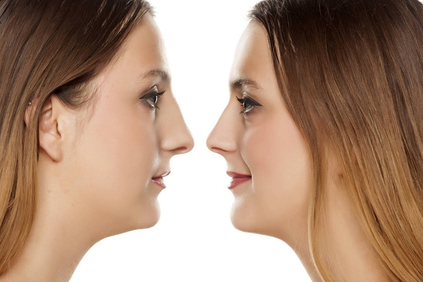 retrato de una mujer joven, antes y después de la rinoplastia
 - Foto, Imagen