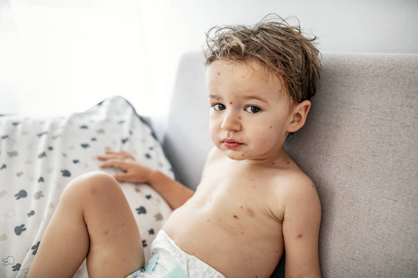 Closeup of cute little boy. Varicella virus or Chickenpox bubble rash on child. Concept quarantine in kindergarten. Portrait of sick little boy. Young toddler with chickenpox - Photo, Image