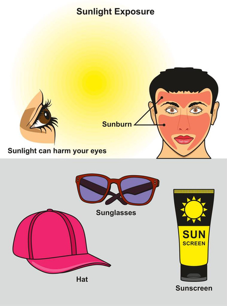 Γραφικό διάγραμμα έκθεσης του ηλιακού φωτός που δείχνει πώς βλάπτει το ανθρώπινο μάτι και το πρόσωπο με ηλιακό έγκαυμα επίσης πώς να το αποφύγει χρησιμοποιώντας καπέλο ηλίου και αντηλιακό για την επιστημονική εκπαίδευση - Διάνυσμα, εικόνα