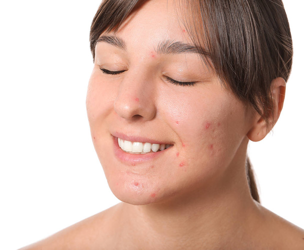 Young woman with acne problem on white background - Photo, Image
