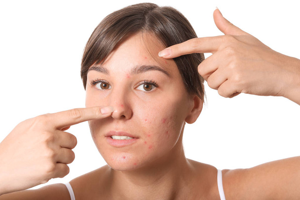 Mujer joven con problemas de acné sobre fondo blanco - Foto, imagen