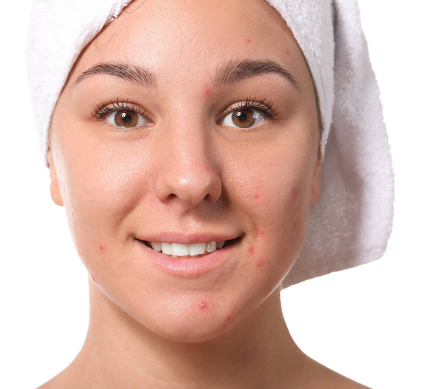 Young woman with acne problem on white background - Valokuva, kuva