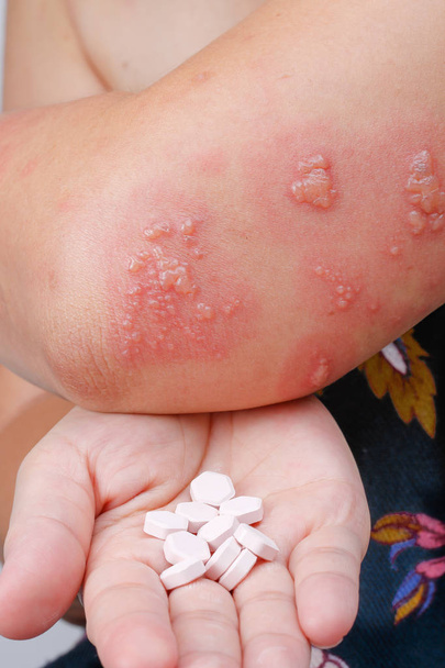 Sintomas de herpes zoster, herpes zoster ou telhas com droga antiviral
 - Foto, Imagem