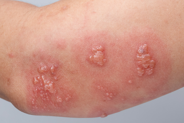 Shingles, zoster of herpes zoster symptomen op arm - Foto, afbeelding