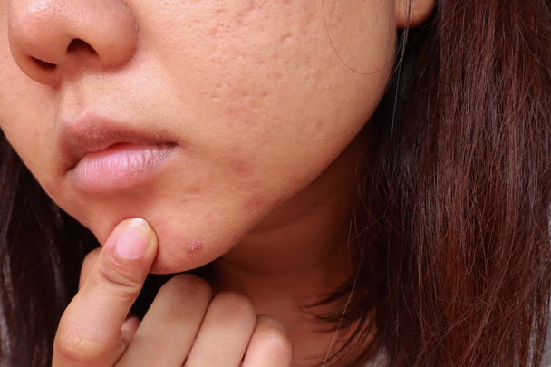 Pustules whitehead acne from face, Problems with acne and scar o - Zdjęcie, obraz