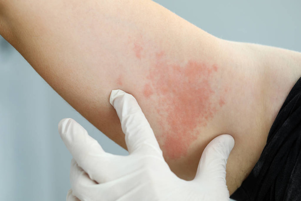 Ispezione allergica rapida
 - Foto, immagini