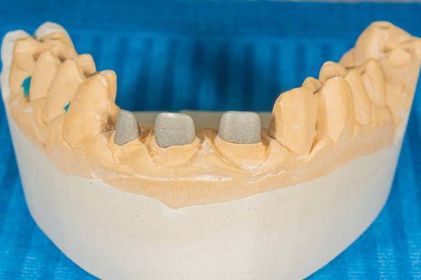 石膏モデルクローズアップ上の人間の歯の金属鋳造ピン  - 写真・画像