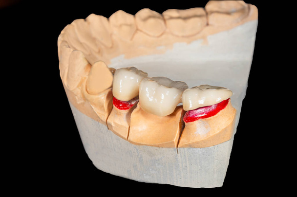 Ceramic tooth crowns and metal pins close-up macro. Orthopedic d - Photo, Image