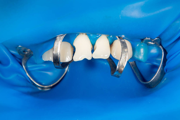 restoration of human teeth affected by caries with photopolymer  - Photo, Image