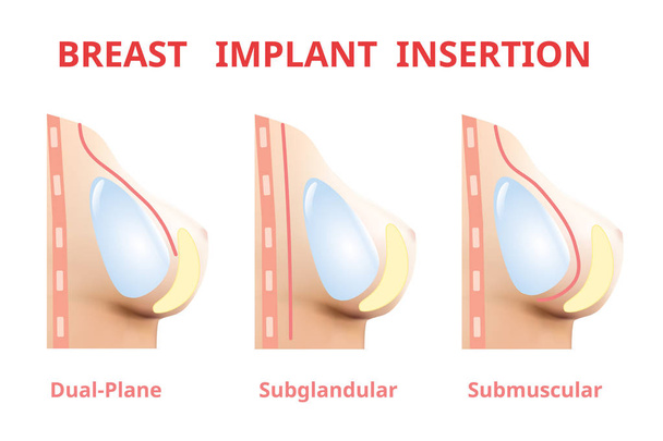 Вставка грудного импланта, силикон для хирургии груди, вектор 3D реалистичного дизайна
. - Вектор,изображение
