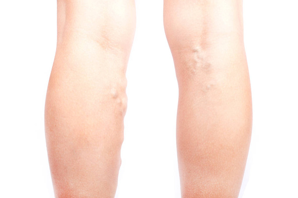 varicose veins on the legs of a girl, phlebeurysm disease - Photo, Image
