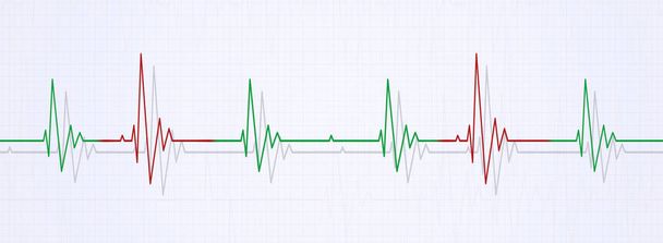 szabálytalan szívverés az EKG - Fotó, kép