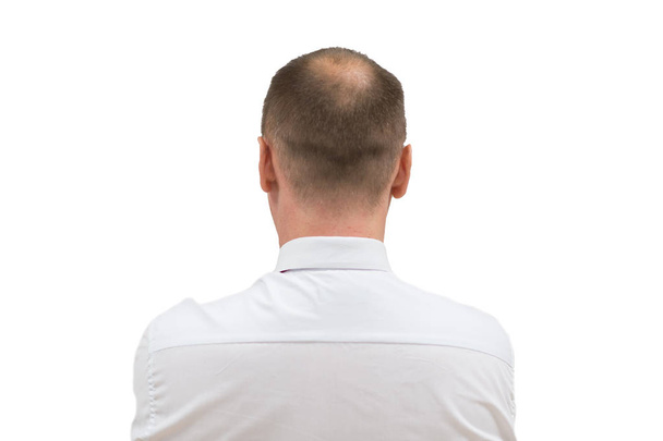 La alopecia humana o la caída del cabello - los hombres adultos calvos cabeza. espalda del hombre calvo de hombros aislados sobre fondo blanco
 - Foto, imagen