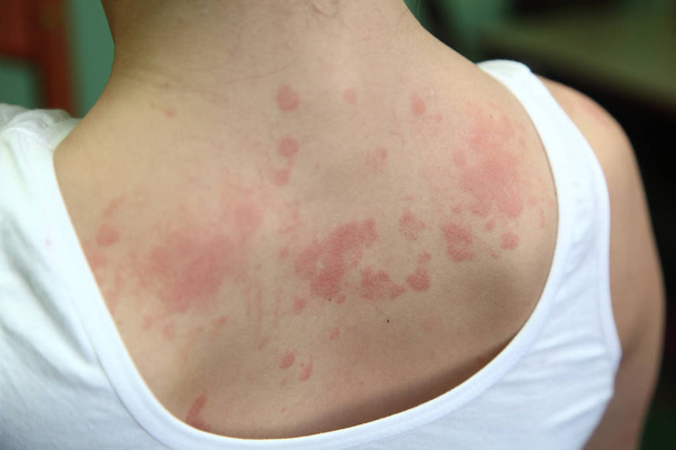 allergic dermatitis - Photo, Image