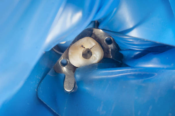Diş köklerinin endodontik tedavisi yakın çekim makro. Minber  - Fotoğraf, Görsel